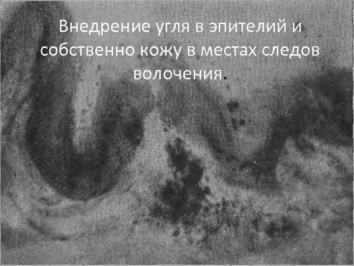 Внедрение угля в эпителий и собственно кожу в местах следов волочения. 