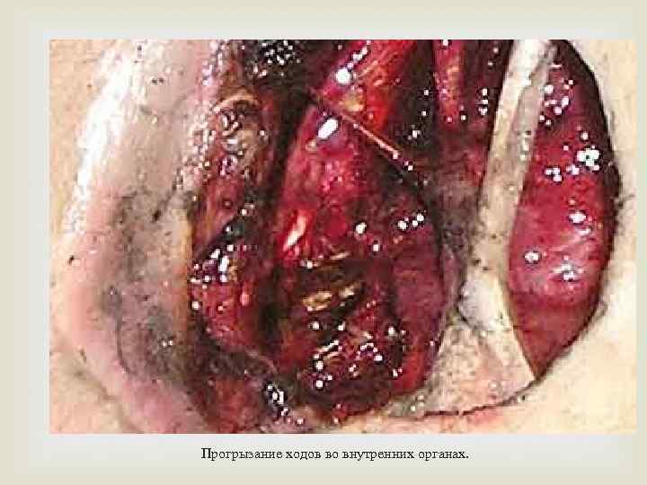 Прогрызание ходов во внутренних органах. 