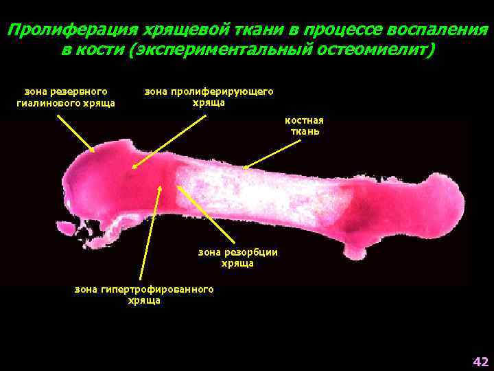 Пролиферация хрящевой ткани в процессе воспаления в кости (экспериментальный остеомиелит) зона резервного гиалинового хряща