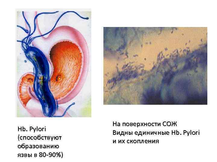 Hb. Pylori (способствуют образованию язвы в 80 -90%) На поверхности СОЖ Видны единичные Hb.