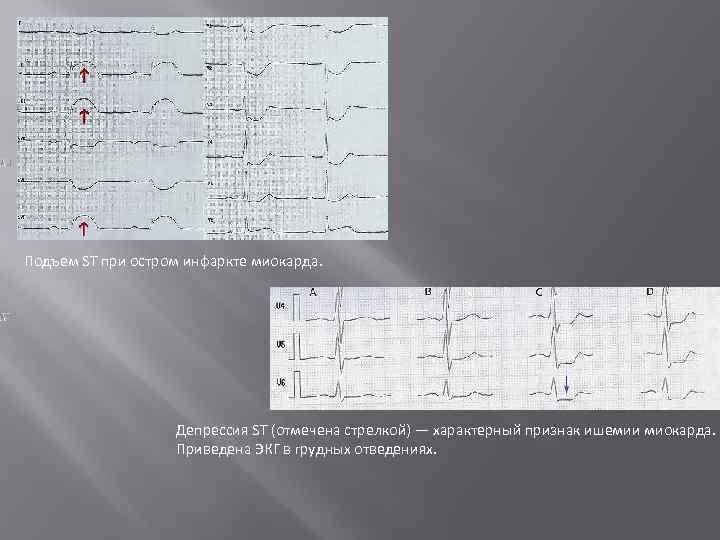 Подъем ST при остром инфаркте миокарда. Депрессия ST (отмечена стрелкой) — характерный признак ишемии