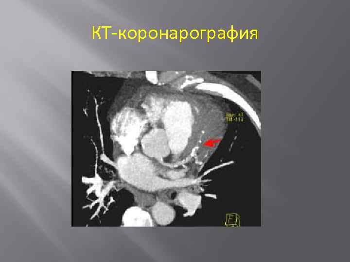 КТ-коронарография 