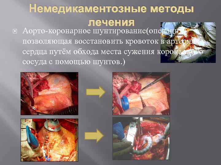 Немедикаментозные методы лечения Аорто-коронарное шунтирование(операция, позволяющая восстановить кровоток в артериях сердца путём обхода места