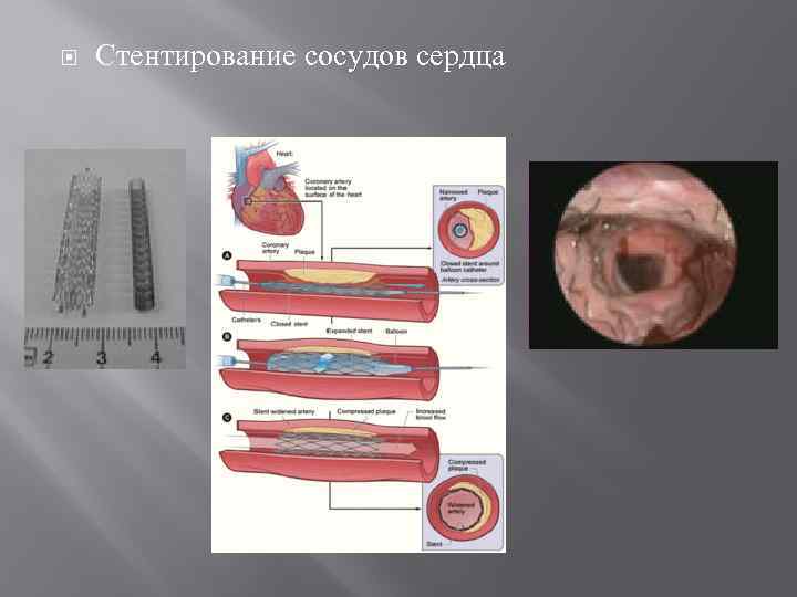  Стентирование сосудов сердца 