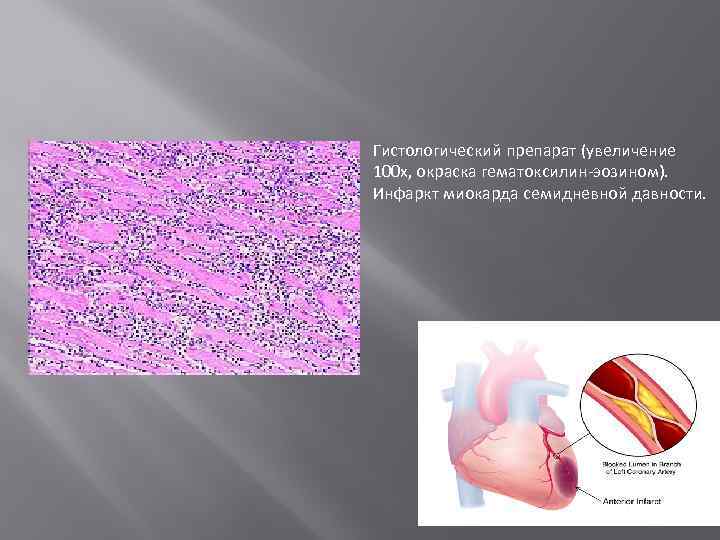 Гистологический препарат (увеличение 100 x, окраска гематоксилин-эозином). Инфаркт миокарда семидневной давности. 