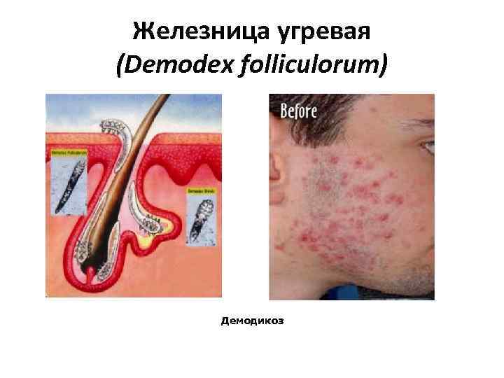  Железница угревая (Demodex folliculorum) Демодикоз 