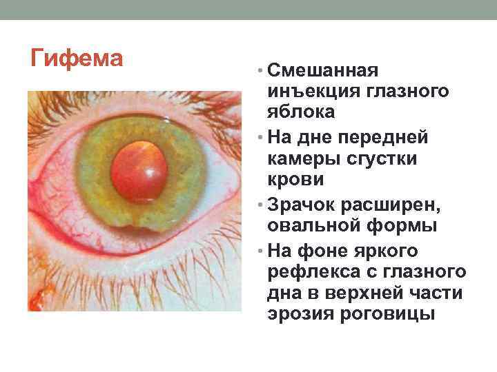 Гифема • Смешанная инъекция глазного яблока • На дне передней камеры сгустки крови •