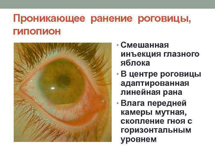 Проникающее ранение роговицы, гипопион • Смешанная инъекция глазного яблока • В центре роговицы адаптированная