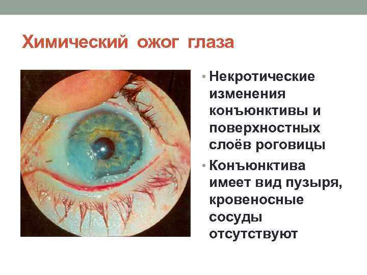Химический ожог глаза • Некротические изменения конъюнктивы и поверхностных слоёв роговицы • Конъюнктива имеет