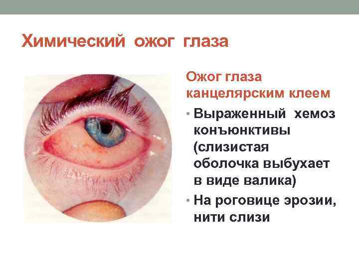Химический ожог глаза Ожог глаза канцелярским клеем • Выраженный хемоз конъюнктивы (слизистая оболочка выбухает
