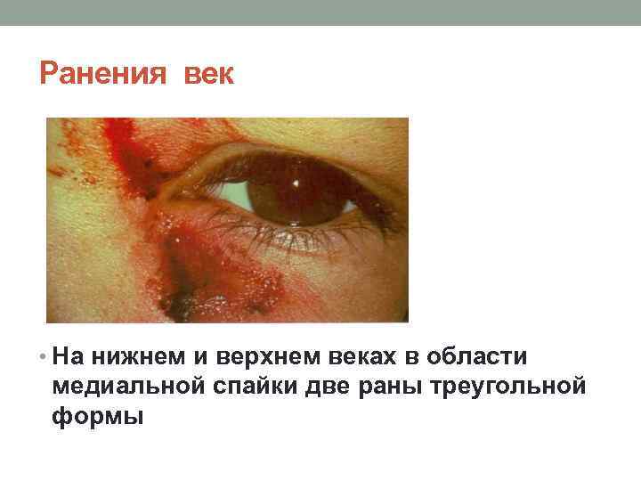 Ранения век • На нижнем и верхнем веках в области медиальной спайки две раны