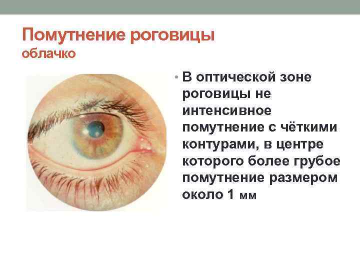 Помутнение роговицы облачко • В оптической зоне роговицы не интенсивное помутнение с чёткими контурами,