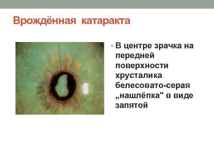 Врождённая катаракта • В центре зрачка на передней поверхности хрусталика белесовато-серая „нашлёпка" в виде