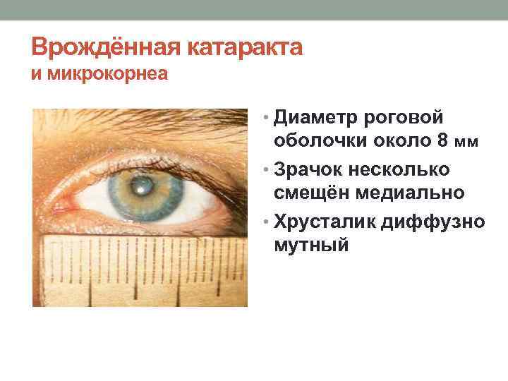 Врождённая катаракта и микрокорнеа • Диаметр роговой оболочки около 8 мм • Зрачок несколько