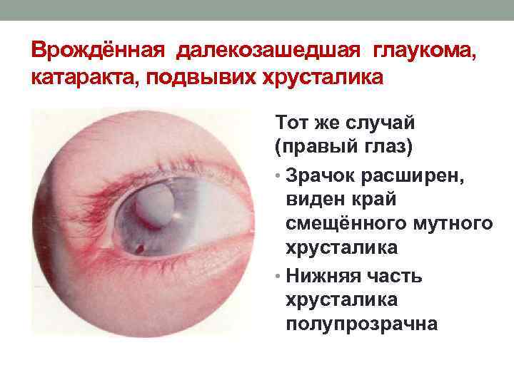 Врождённая далекозашедшая глаукома, катаракта, подвывих хрусталика Тот же случай (правый глаз) • Зрачок расширен,