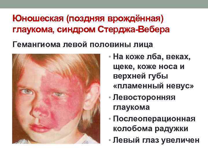 Юношеская (поздняя врождённая) глаукома, синдром Стерджа-Вебера Гемангиома левой половины лица • На коже лба,