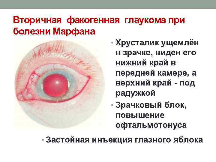 Вторичная факогенная глаукома при болезни Марфана • Хрусталик ущемлён в зрачке, виден его нижний