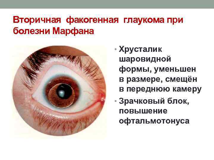 Вторичная факогенная глаукома при болезни Марфана • Хрусталик шаровидной формы, уменьшен в размере, смещён
