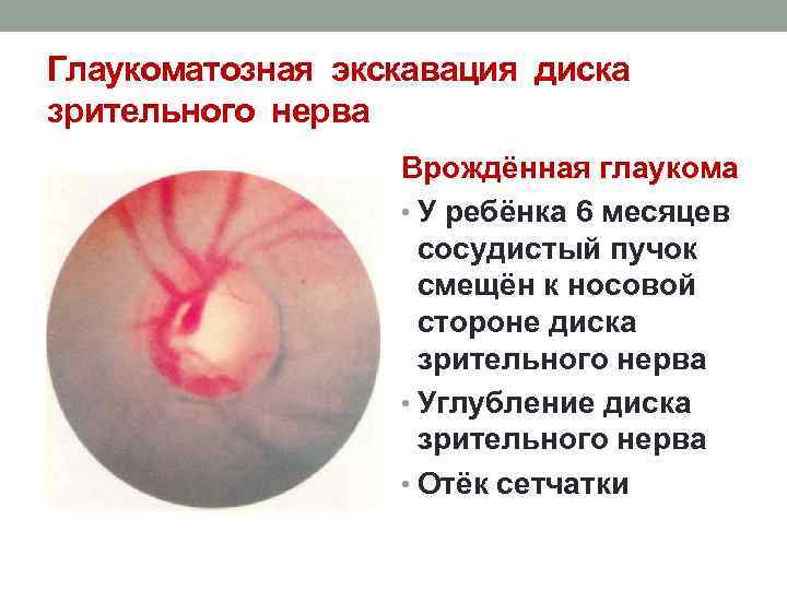 Глаукоматозная экскавация диска зрительного нерва Врождённая глаукома • У ребёнка 6 месяцев сосудистый пучок