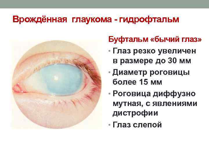 Врождённая глаукома - гидрофтальм Буфтальм «бычий глаз» • Глаз резко увеличен в размере до