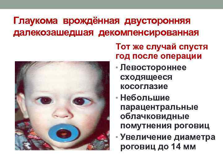 Глаукома врождённая двусторонняя далекозашедшая декомпенсированная Тот же случай спустя год после операции • Левостороннее