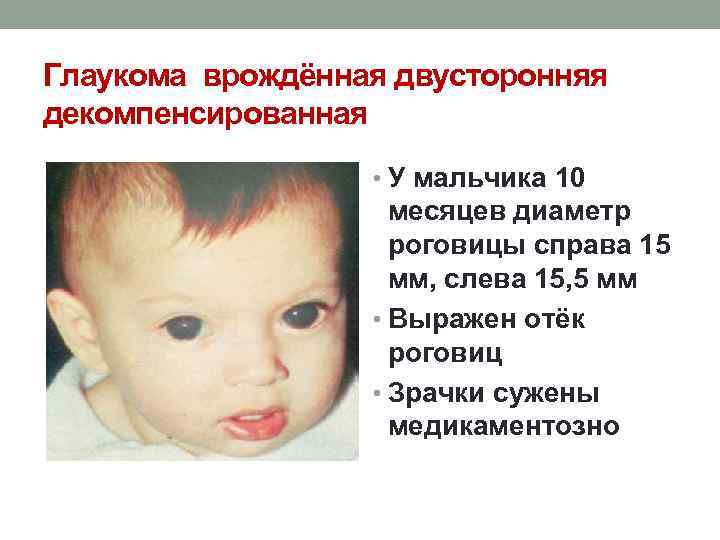 Глаукома врождённая двусторонняя декомпенсированная • У мальчика 10 месяцев диаметр роговицы справа 15 мм,