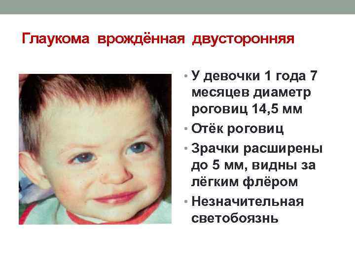 Глаукома врождённая двусторонняя • У девочки 1 года 7 месяцев диаметр роговиц 14, 5