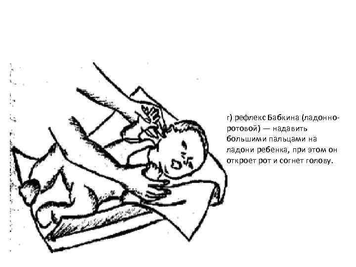 г) рефлекс Бабкина (ладонно ротовой) — надавить большими пальцами на ладони ребенка, при этом
