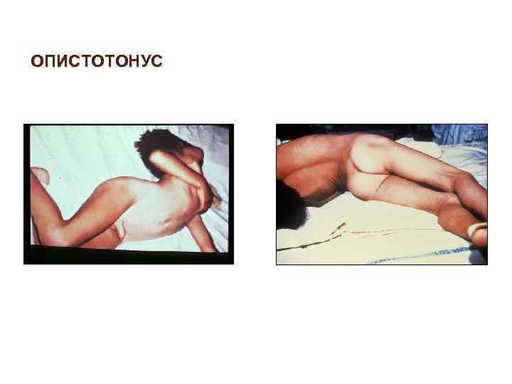 ОПИСТОТОНУС 