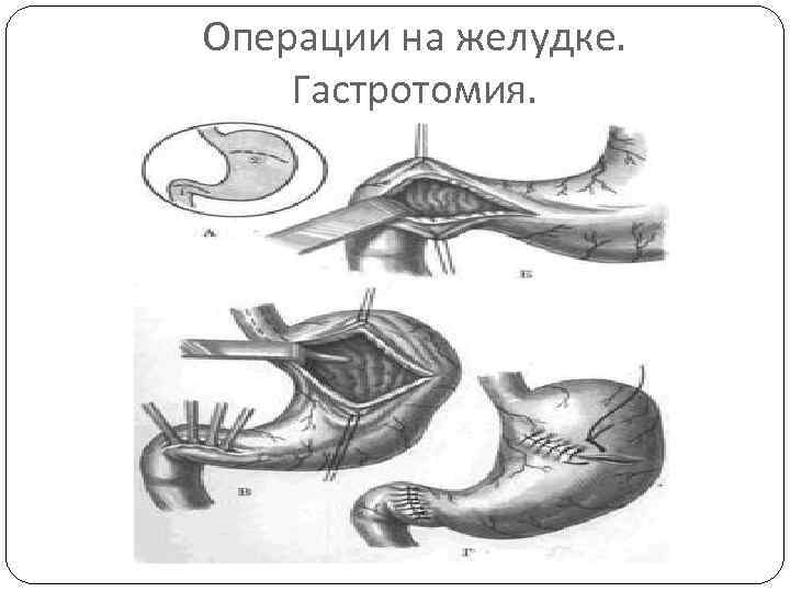 Операции на желудке. Гастротомия. 