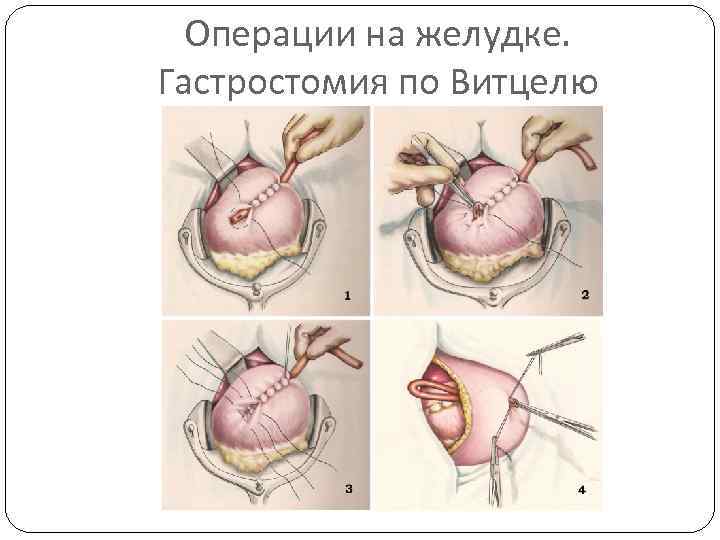 Операции на желудке. Гастростомия по Витцелю 