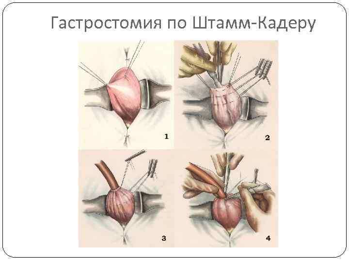 Гастростомия по Штамм-Кадеру 