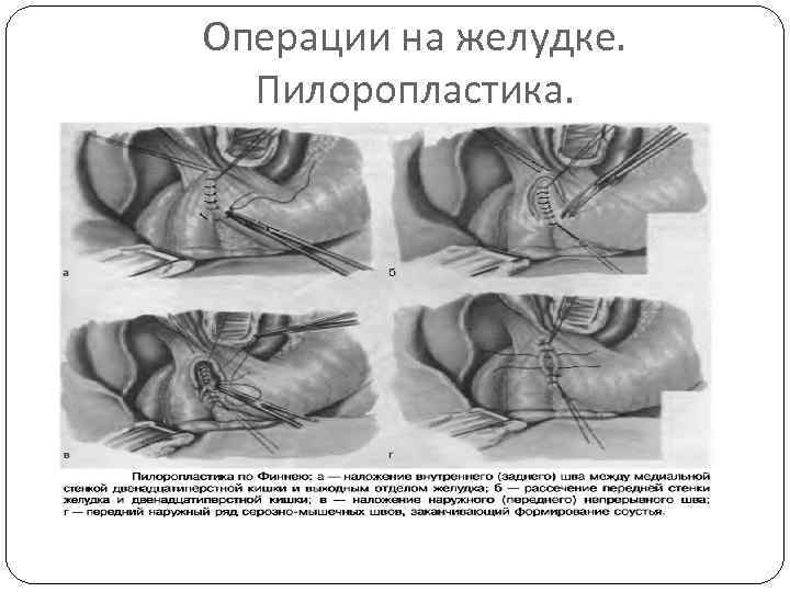 Операции на желудке. Пилоропластика. 