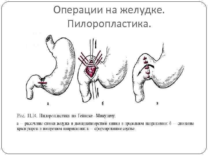Операции на желудке. Пилоропластика. 
