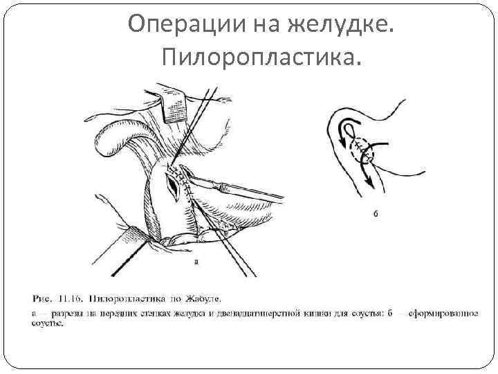 Операции на желудке. Пилоропластика. 