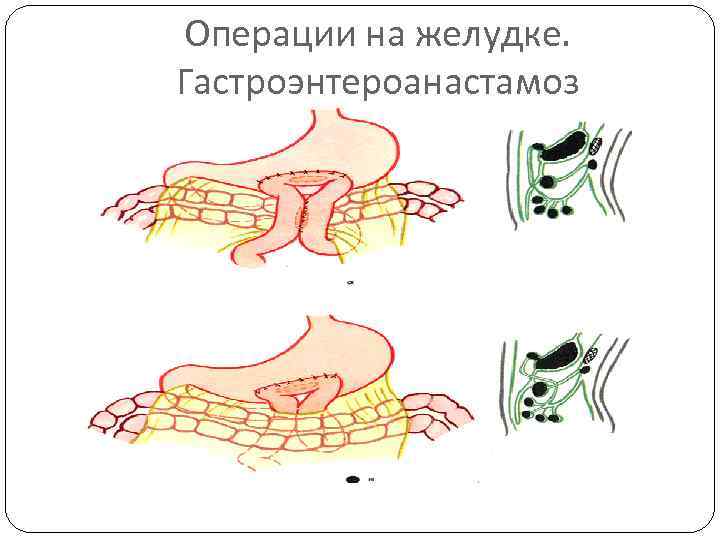 Операции на желудке. Гастроэнтероанастамоз 