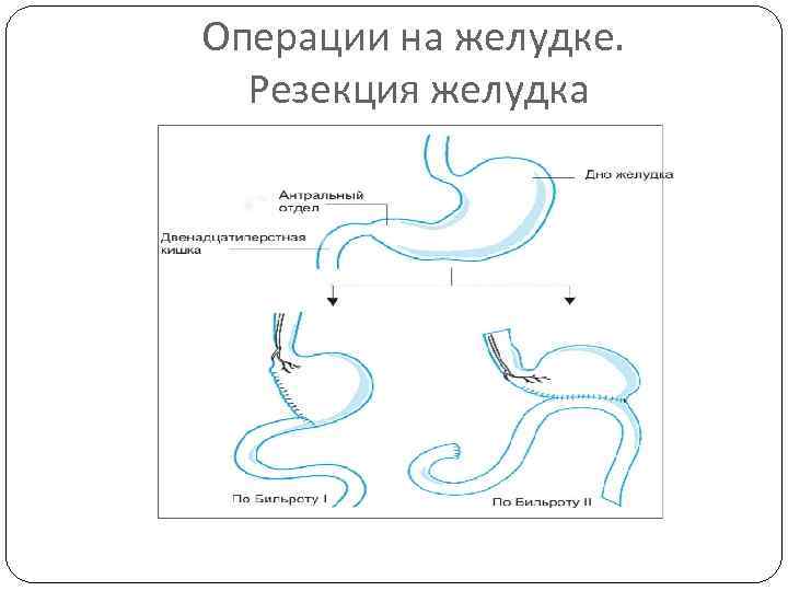 Операции на желудке. Резекция желудка 