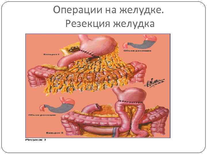 Операции на желудке. Резекция желудка 