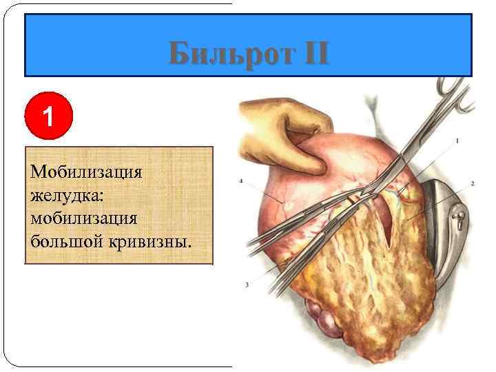 Бильрот II 1 Мобилизация желудка: мобилизация большой кривизны. 