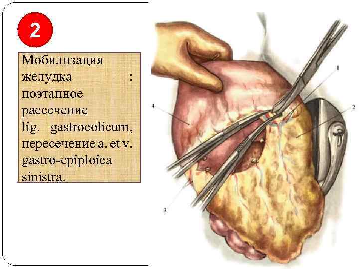 2 Мобилизация желудка : поэтапное рассечение lig. gastrocolicum, пересечение a. et v. gastro-epiploica sinistra.