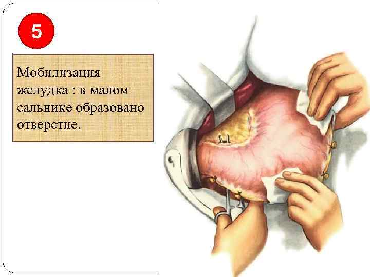 5 Мобилизация желудка : в малом сальнике образовано отверстие. 