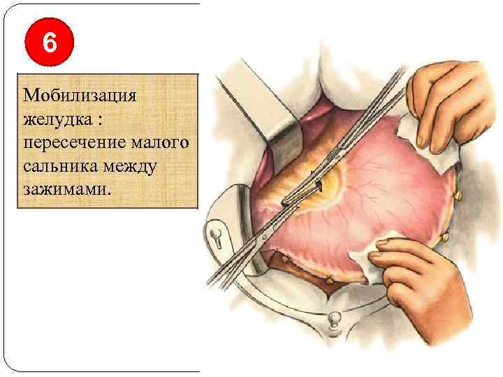 6 Мобилизация желудка : пересечение малого сальника между зажимами. 