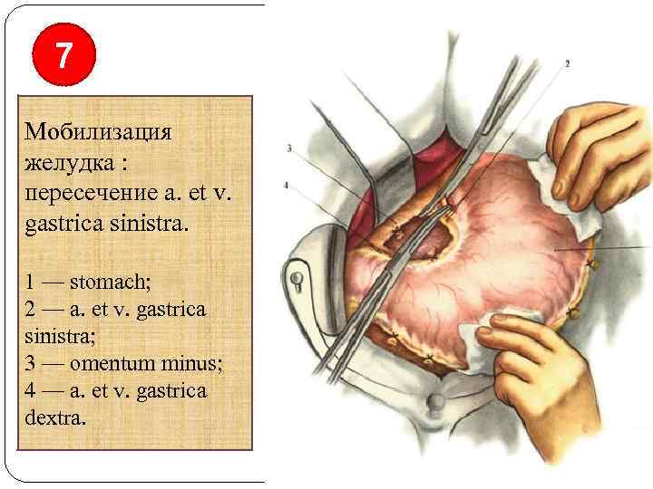 7 Мобилизация желудка : пересечение а. et v. gastrica sinistra. 1 — stomach; 2