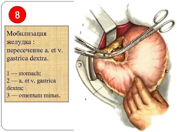 8 Мобилизация желудка : пересечение a. et v. gastrica dextra. 1 — stomach; 2