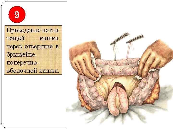9 Проведение петли тощей кишки через отверстие в брыжейке поперечноободочной кишки. 