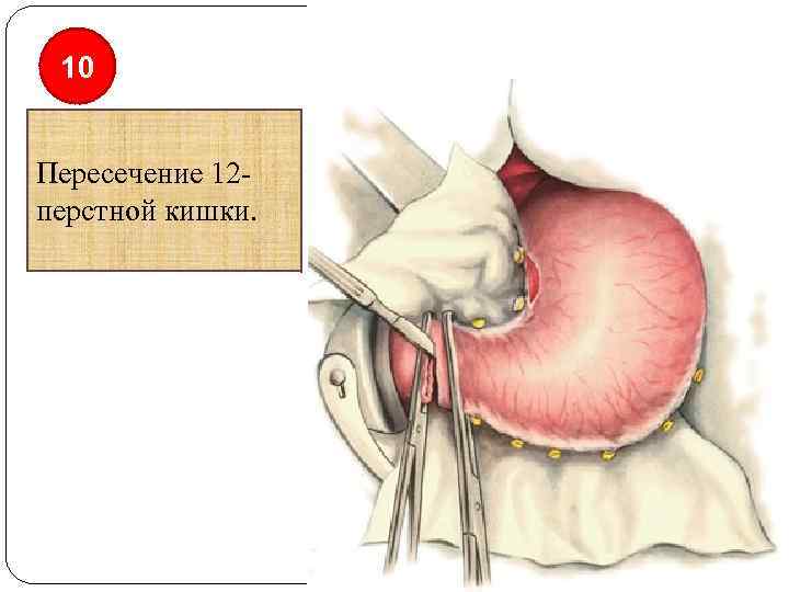 10 Пересечение 12 перстной кишки. 