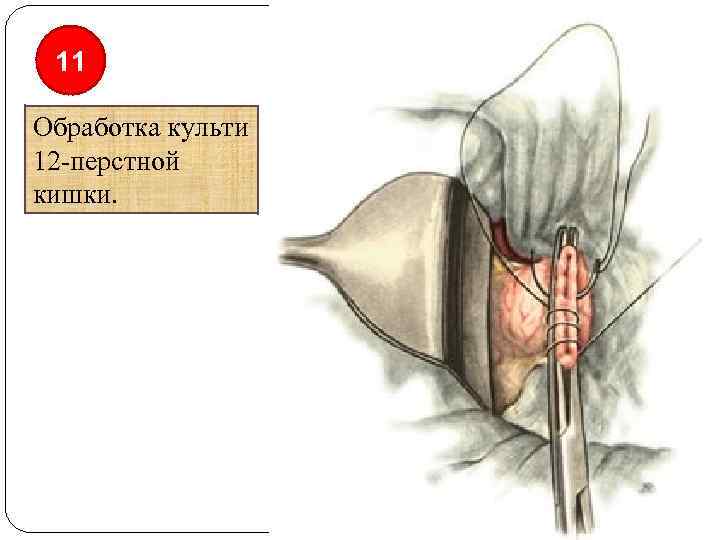 11 Обработка культи 12 -перстной кишки. 