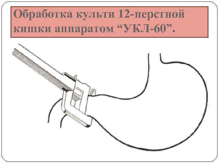 Клапан 12 перстной кишки