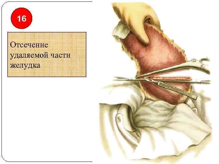 16 Отсечение удаляемой части желудка 