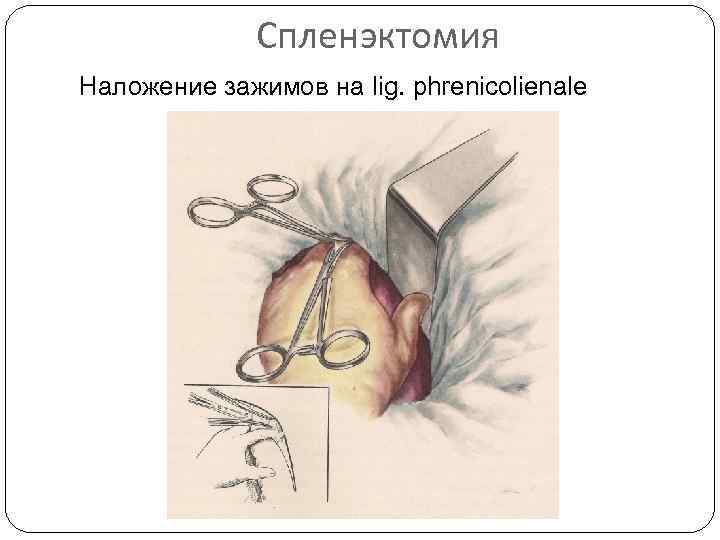 Спленэктомия Наложение зажимов на lig. phrenicolienale 